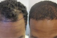 hair transplant for african american -Who is the Right Candidate for African American Hair Transplant?