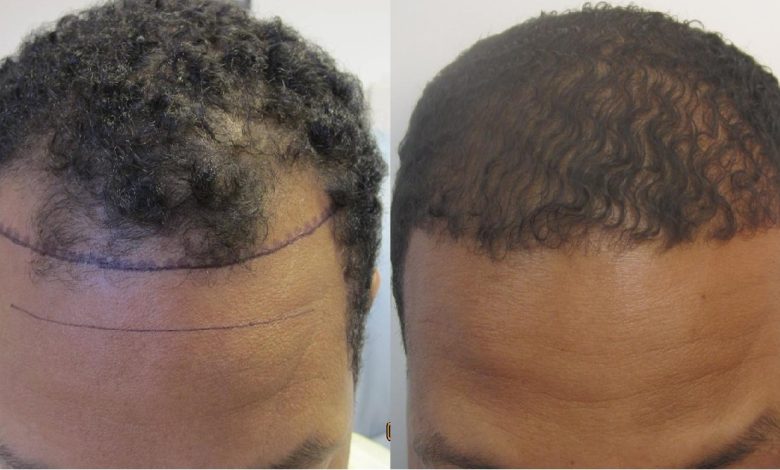 hair transplant for african american -Who is the Right Candidate for African American Hair Transplant?