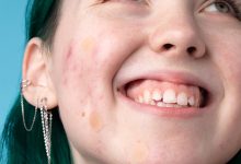 acne dots