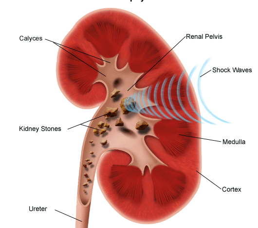 lithotripsy