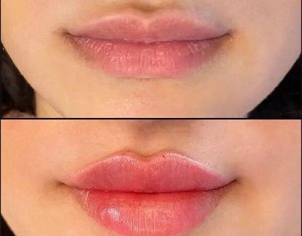 Russian Lip Fillers Migration