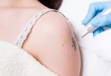 Best Tattoo Removal Clinic